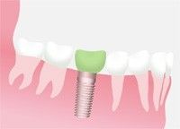 Implantate Zahnarzt
